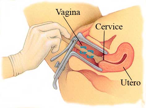 Prelievo pap test dalla cervice uterina