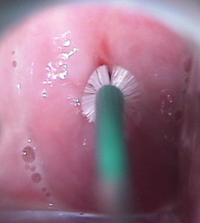 PRELIEVO CITOLOGICO PER PAP TEST CON SPAZZOLINO ENDOCERVICALE O CITOBRUSCH