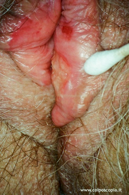 Carcinoma vulvare