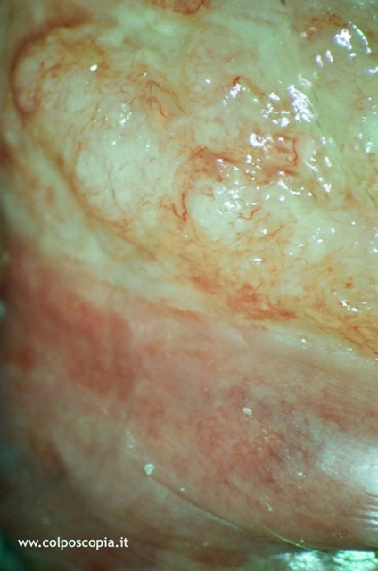 Carcinoma vulvare