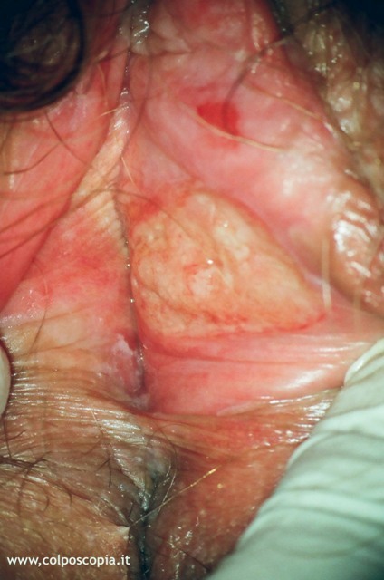 Carcinoma vulvare