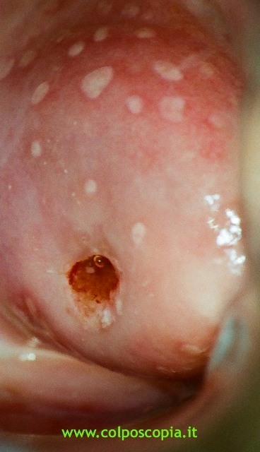 Colpite focale da HPV