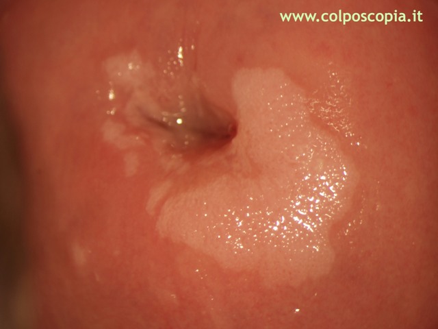 CONDILOMA MICROFLORIDO DELLA CERVICE UTERINA