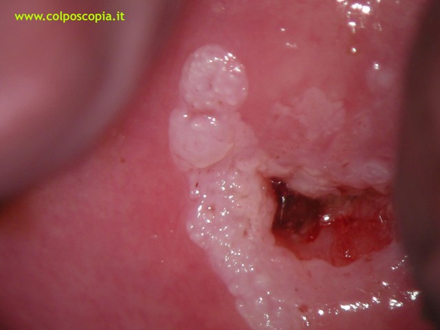 CONDILOMA MICROFLORIDO DELLA CERVICE UTERINA