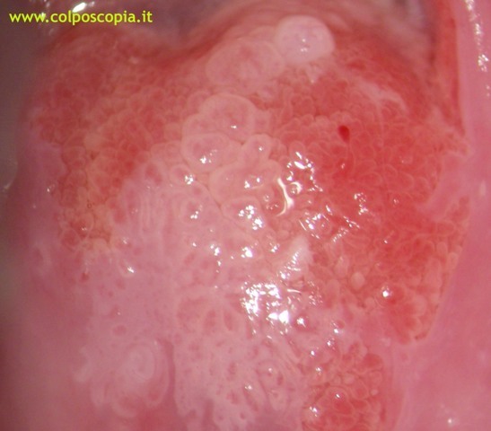 CONDILOMA SUBCLINICO CERVICALE SU AREA METAPLASICA