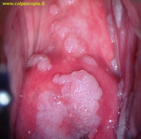 CONDILOMATOSI FLORIDA CERVICE E FORNICE VAGINALE