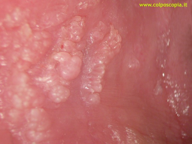 Particolare condilomatosi microflorida parete vaginale