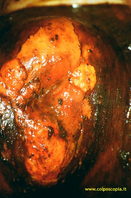 CONDILONMA CHERATOSIFORME