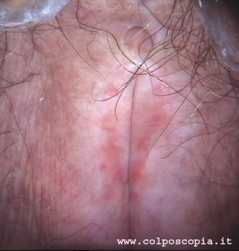 Lichen sclerosus