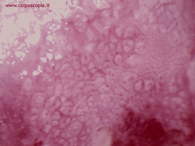 MOSAICO IRREGOLARE CON IRREGOLARITA' VASCOLARE Ca in situ