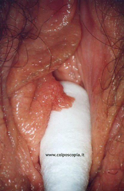 Papilloma virus grandi labbra. Semne zodiacale de marime penis
