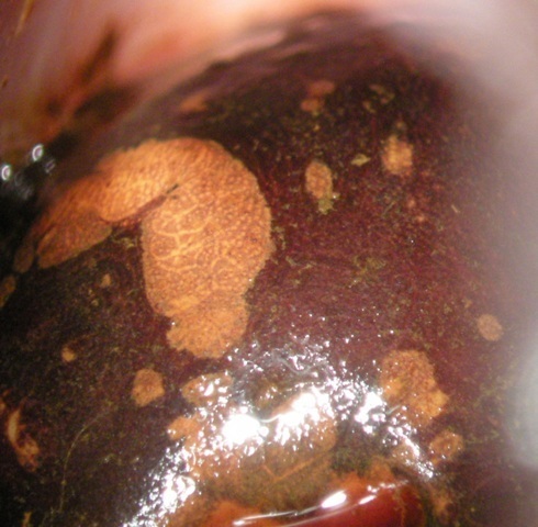 PUNTATO HPV