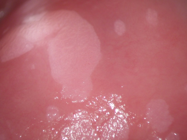 PUNTATO HPV