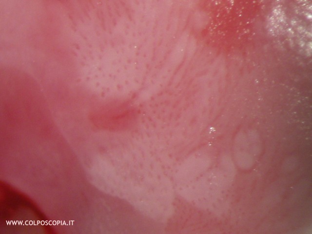 PUNTATO REGOLARE CIN1 HPV