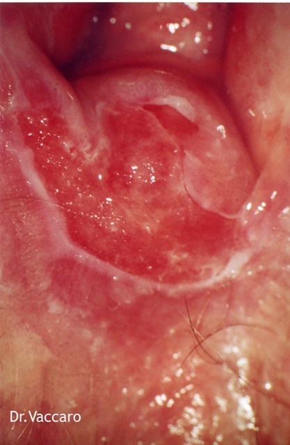 Carcinoma vulvare