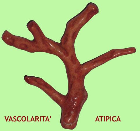 IRREGOLARE RAMIFICAZIONE VASCOLARE