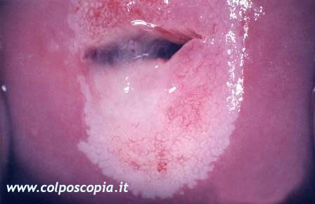 COLPOSCOPIA DI UNA LESIONE CERVICALE PIATTA DA HPV ( HUMAN PAPILLOMAVIRUS )