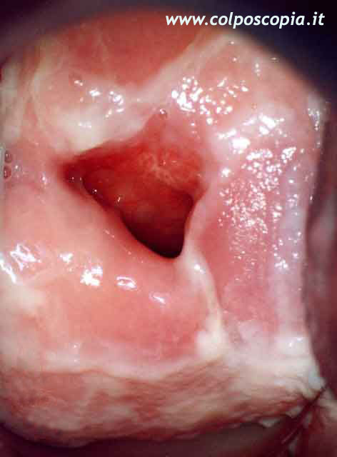 papilloma virus perdite)