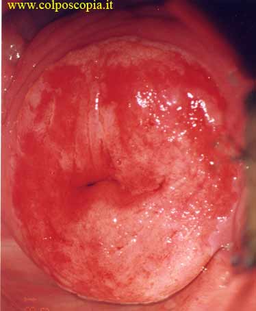 negii cervicali ectopia colului uterin)
